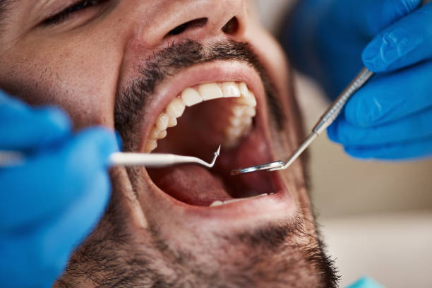 Best Emergency Wisdom Teeth Removal in Raymond, IL