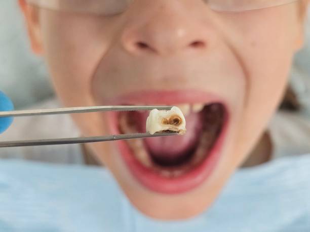 Best Emergency Tooth Extraction in Raymond, IL